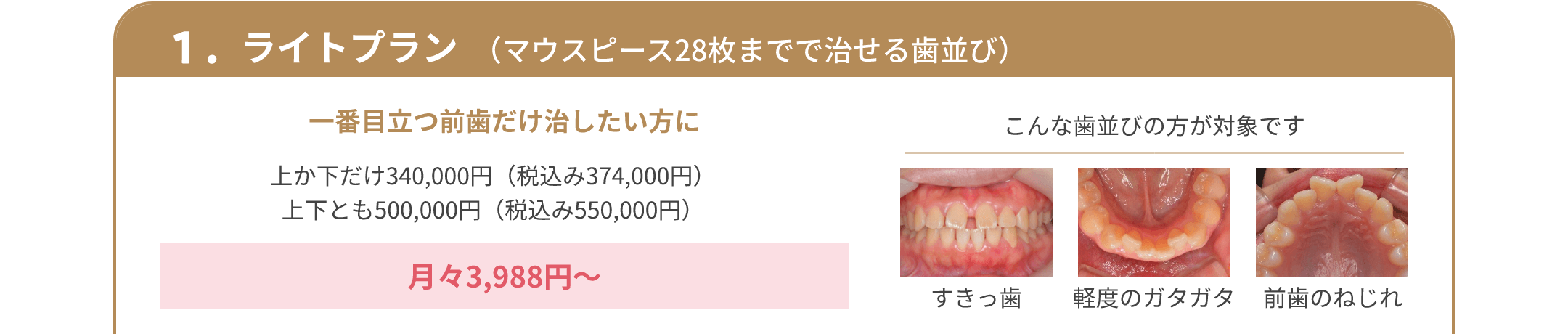 1.ライトプラン （マウスピース28枚までで治せる歯並び） 一番目立つ前歯だけ治したい方に 上か下だけ340,000円（税込み374,000円） 上下とも500,000円（税込み550,000円） 月々3,988円～ こんな歯並びの方が対象です すきっ歯 軽度のガタガタ 前歯のねじれ