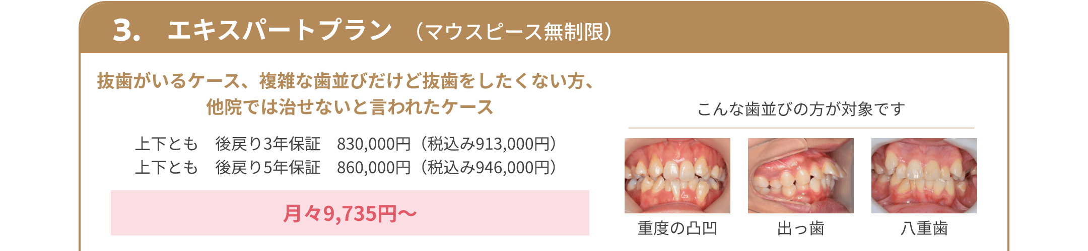 3.エキスパートプラン （マウスピース無制限） 抜歯がいるケース、複雑な歯並びだけど抜歯をしたくない方、他院では治せないと言われたケース 上下とも 後戻り3年保証 830,000円（税込み913,000円） 上下とも 後戻り5年保証 860,000円（税込み946,000円） 月々9,735円～ こんな歯並びの方が対象です 重度の凸凹 出っ歯 八重歯