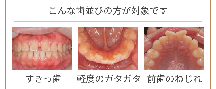 こんな歯並びの方が対象です すきっ歯 軽度のガタガタ 前歯のねじれ
