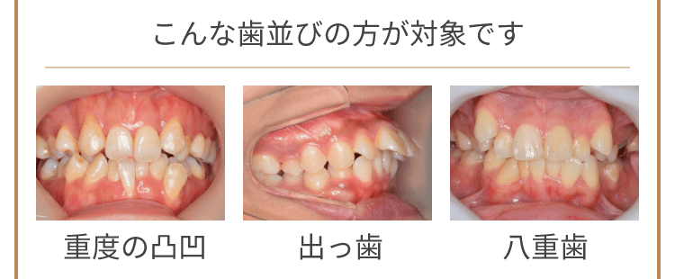 こんな歯並びの方が対象です 重度の凸凹 出っ歯 八重歯