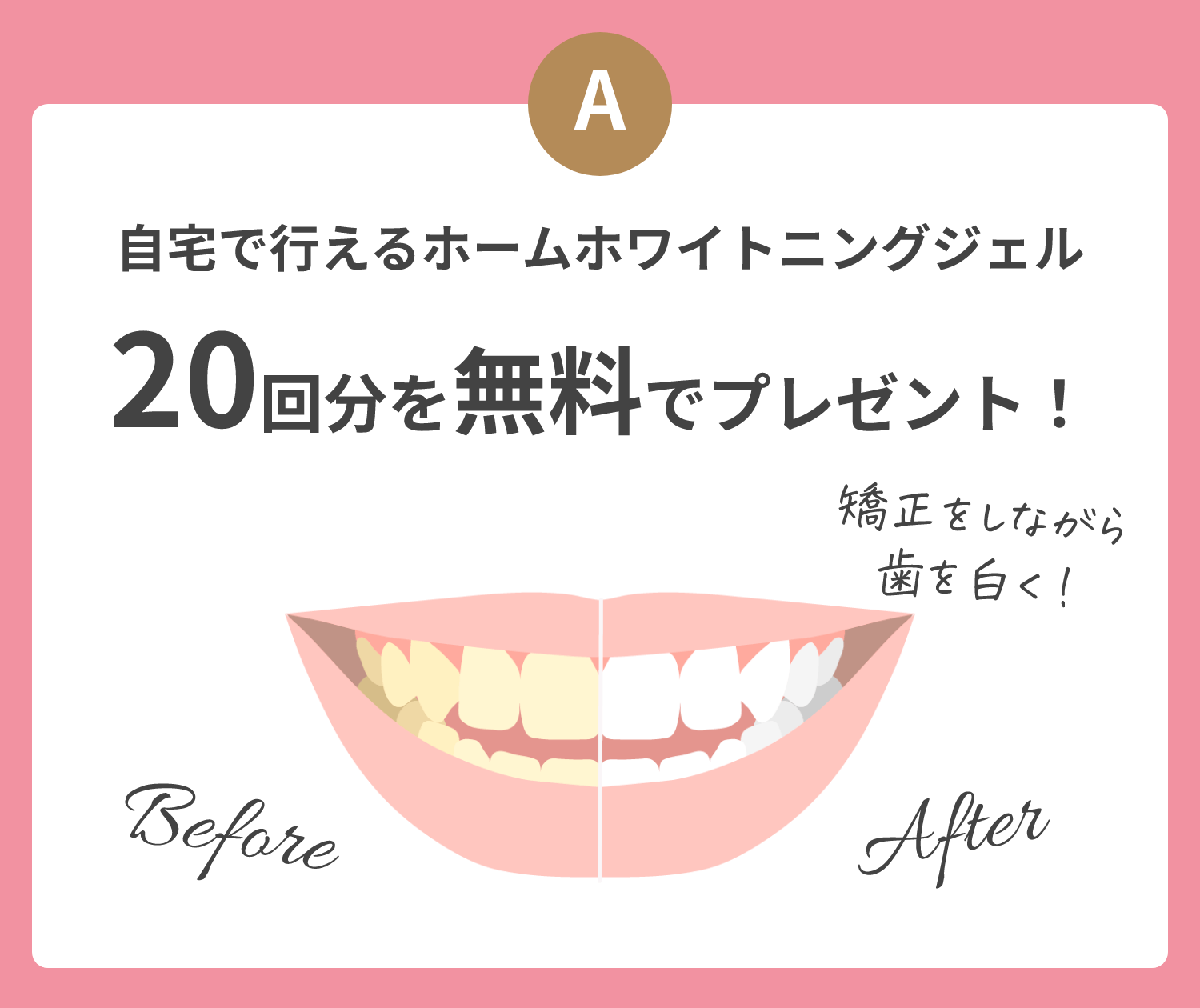 A 自宅で行えるホームホワイトニングジェル20回分を無料でプレゼント！ 矯正をしながら歯を白く！ before after