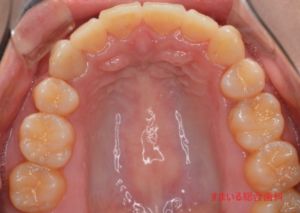マウスピース矯正の失敗について 愛媛 松山 マウスピース矯正相談室 In すまいる総合歯科クリニック